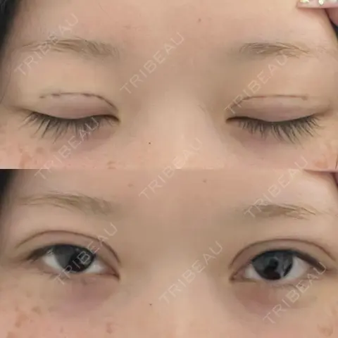 二重埋没 / 自然癒着法 Brandnew Beauty Clinic DAY 0