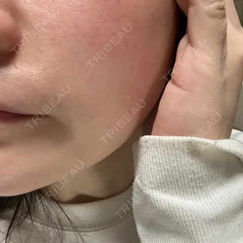 白玉点滴・注射 湘南美容クリニック 千葉センシティ院 AFTER