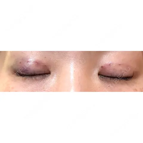 二重埋没 / 自然癒着法 Brandnew Beauty Clinic DAY 0