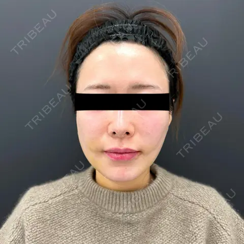 糸リフト / 脂肪吸引（顔） BLINC CLINIC （ブリンク クリニック） DAY 7