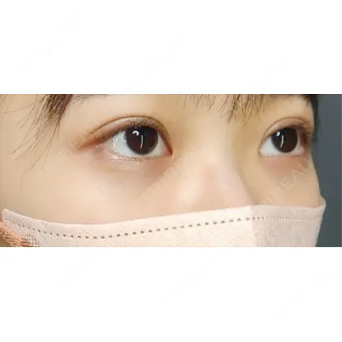 クマ治療 / 下まぶたたるみ取り / ヒアルロン酸注入（目の下） Tokyo Tensei Clinic 新宿院 AFTER