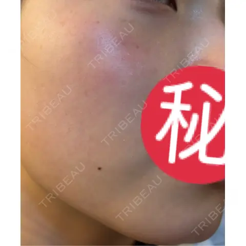 エレクトロポレーション / ルメッカ ゆきスキンクリニック 東池袋 AFTER