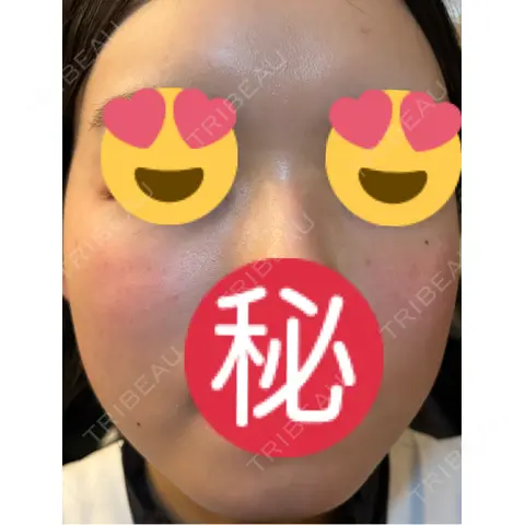 エレクトロポレーション / ルメッカ ゆきスキンクリニック 東池袋 AFTER