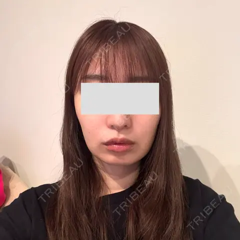脂肪吸引（顔） Mods Clinic（モッズクリニック） 東京院 DAY 35