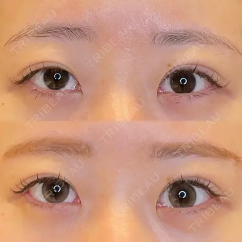 目尻切開 / タレ目形成・グラマラスライン（埋没） / 美容点滴・美容注射（美肌） LOUIS CLINIC 二子玉川院【ルイクリニック】 AFTER