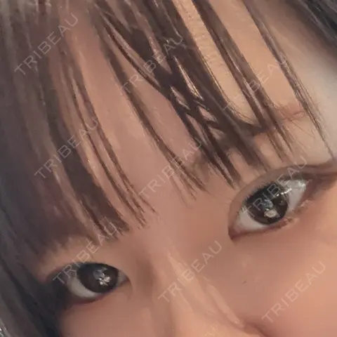二重埋没 東京シンデレラ美容外科 大宮院 AFTER