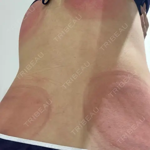 脂肪冷却（お腹） / 脂肪冷却（背中・ブラファット） DMTC美容皮膚科 渋谷院 DAY 0