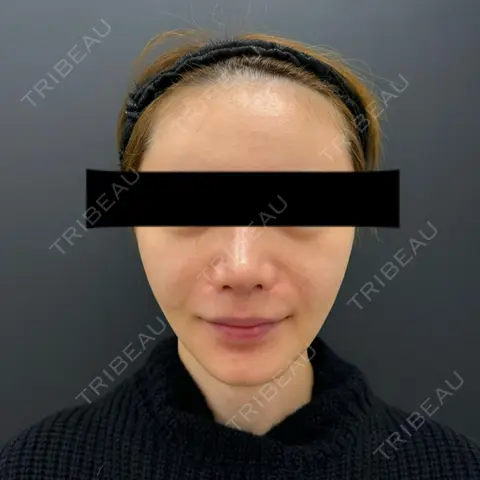 脂肪吸引（顔） BLINC CLINIC （ブリンク クリニック） DAY 7