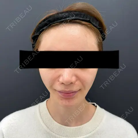 脂肪吸引（顔） BLINC CLINIC （ブリンク クリニック） AFTER