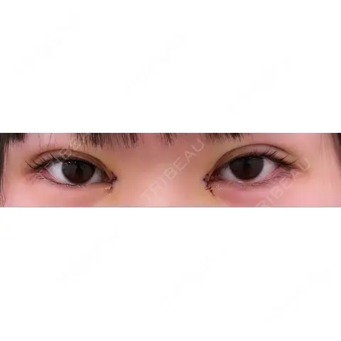 二重埋没 / 目頭切開 / ヒアルロン酸注入（涙袋） 東京シンデレラ美容外科 池袋院 DAY 0