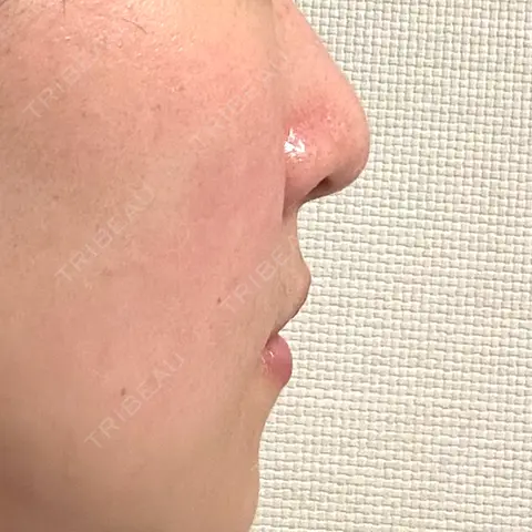 鼻尖形成（非切開） 銀座マイアミ美容外科 AFTER