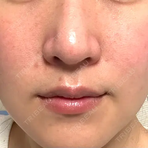 鼻尖形成（非切開） 銀座マイアミ美容外科 AFTER