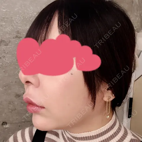 RF（高周波）たるみ治療 ウィルビークリニック 新宿院 AFTER