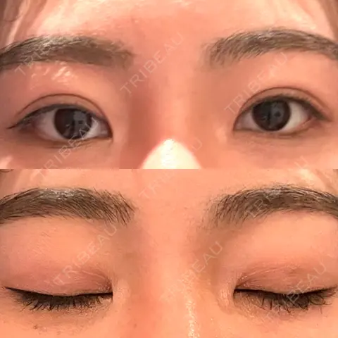 二重埋没 WOM CLINIC GINZA （ワム クリニック ギンザ） AFTER