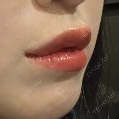 ヒアルロン酸注入（唇） / ボトックス（人中） 上野美容外科・美容皮膚科 AFTER