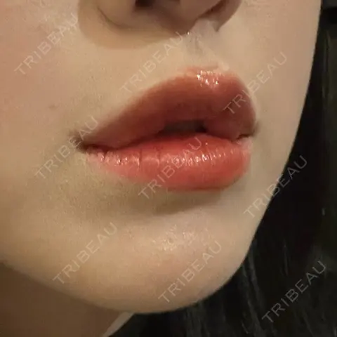 ヒアルロン酸注入（唇） / ボトックス（人中） 上野美容外科・美容皮膚科 AFTER