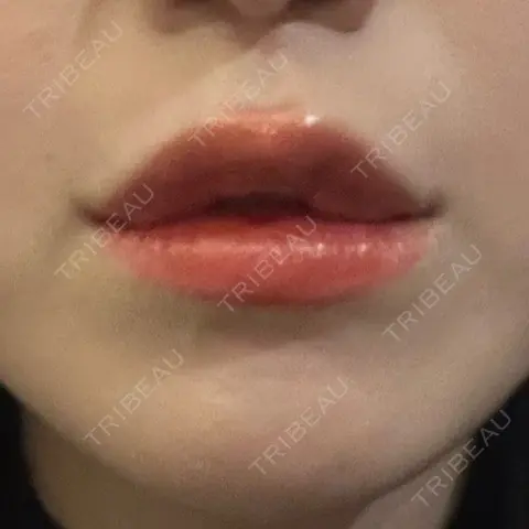 ヒアルロン酸注入（唇） / ボトックス（人中） 上野美容外科・美容皮膚科 AFTER