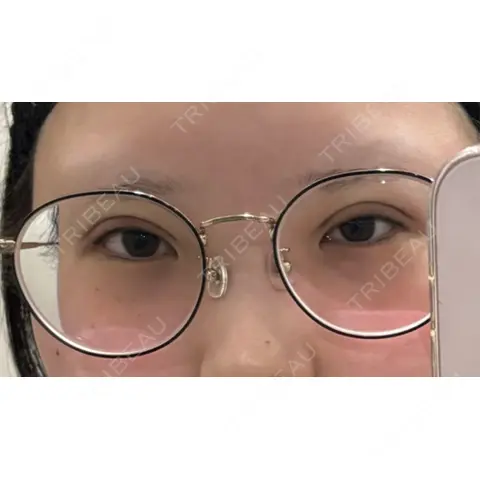 二重埋没 / 上まぶたの脂肪取り / ボトックス（眉間） / ボトックス（額） 藤・ナチュレ美容クリニック 銀座院 DAY 0