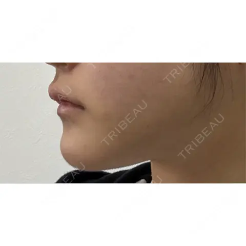 糸リフト / 脂肪吸引（顔） 4Dクリニック AFTER