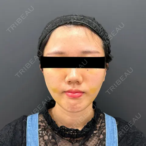 糸リフト / 脂肪吸引（顔） BLINC CLINIC （ブリンク クリニック） DAY 7