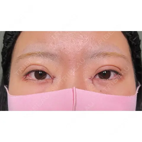 二重埋没 / 目頭切開 HAAB×DREAM BEAUTY CLINIC 大阪梅田院 DAY 0