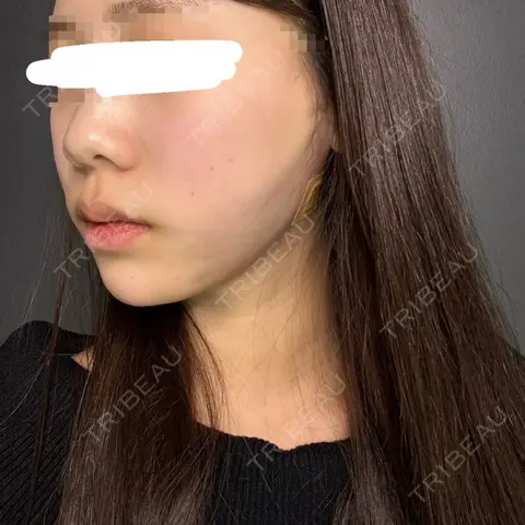 糸リフト / 脂肪吸引（顔） / ボトックス（あご） / ヒアルロン酸注入（あご） Tokyo Tensei Clinic 新宿院 AFTER