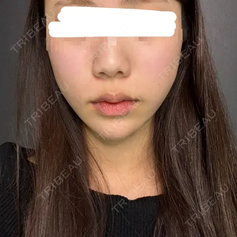 糸リフト / 脂肪吸引（顔） / ボトックス（あご） / ヒアルロン酸注入（あご） Tokyo Tensei Clinic 新宿院 AFTER