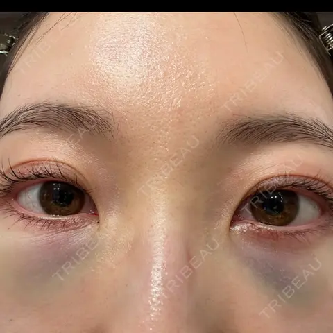 クマ治療 / 下まぶたの脂肪取り APOLLO BEAUTY CLINIC DAY 0