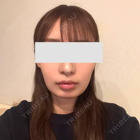 脂肪吸引（顔） Mods Clinic（モッズクリニック） 東京院 AFTER