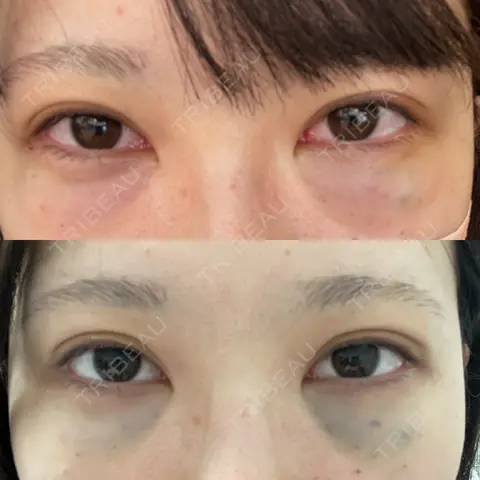 クマ治療 / 下まぶたたるみ取り / ヒアルロン酸注入（目の下） / その他（目元） Tokyo Tensei Clinic 新宿院 DAY 0