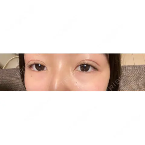 二重埋没 アリエル美容クリニック 大宮院 DAY 0