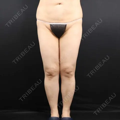 脂肪吸引（脚） 藤・ナチュレ美容クリニック 銀座院 DAY 30