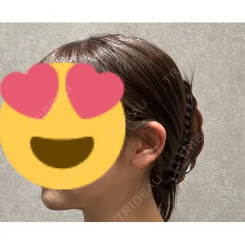 糸リフト / 脂肪吸引（顔） 脂肪吸引ラボトウキョウ AFTER