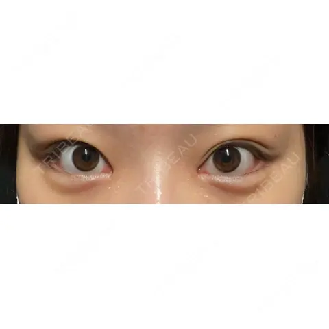 目頭切開 / タレ目形成・グラマラスライン（切開） R Beauty CLINIC 大阪院 AFTER