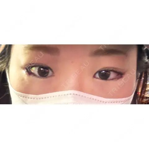 目尻切開 東京BELLEZZAクリニック AFTER