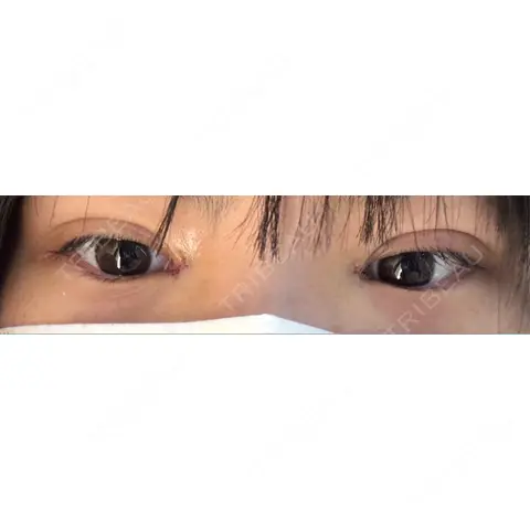 二重埋没 / 目頭切開 東京シンデレラ美容外科 池袋院 DAY 0