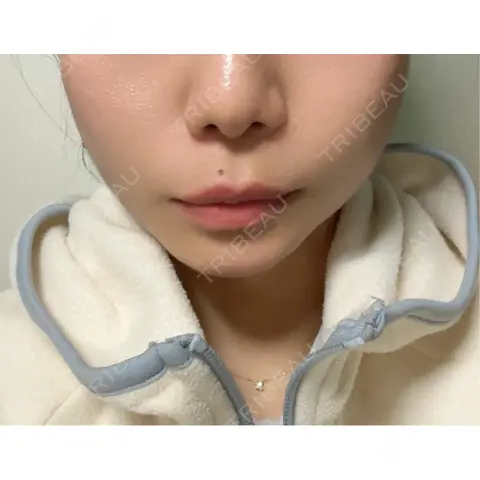 ボトックス（エラ・小顔） TCB東京中央美容外科 中野院 AFTER