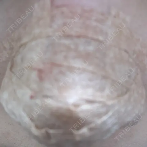 鼻尖形成（切開） / 軟骨移植 RIVER CLINIC（リバークリニック） DAY 1
