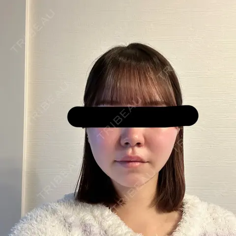 脂肪吸引（顔） / 脂肪吸引注射（顔） SEA CLINIC（シークリニック） AFTER