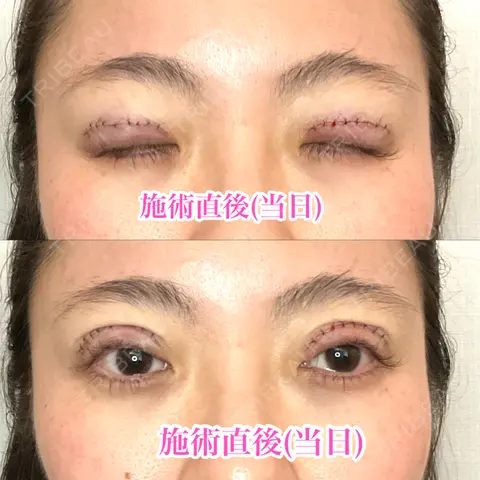 眼瞼下垂（切開） 形成外科と美容外科のクリニック池袋 DAY 0