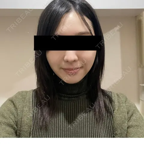 糸リフト / 脂肪吸引（顔） / ジョールファット除去 / 脂肪吸引注射（顔） SEA CLINIC（シークリニック） AFTER