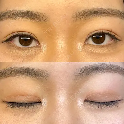 二重埋没 WOM CLINIC GINZA （ワム クリニック ギンザ） AFTER