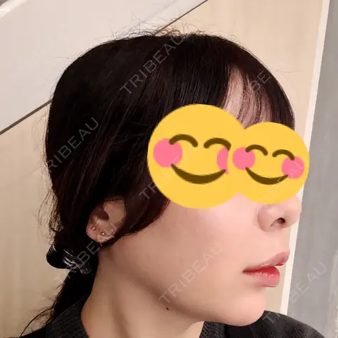 RF（高周波）たるみ治療 ウィルビークリニック 新宿院 AFTER