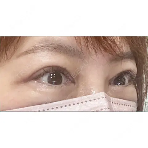 眼瞼下垂（切開） 博多もへじのクリニック AFTER
