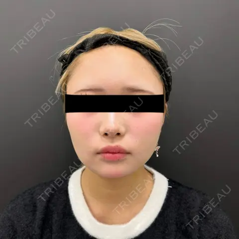 糸リフト / 脂肪吸引（顔） BLINC CLINIC （ブリンク クリニック） DAY 8