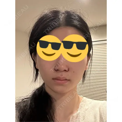 小鼻縮小（切開） くさのたろうクリニック DAY 0