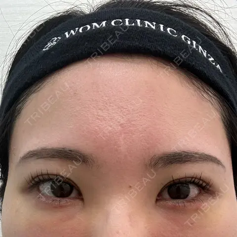 クマ治療 WOM CLINIC GINZA （ワム クリニック ギンザ） AFTER
