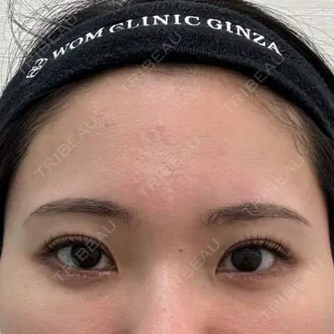 クマ治療 WOM CLINIC GINZA （ワム クリニック ギンザ） AFTER