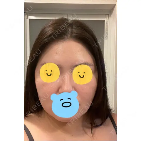 脂肪吸引（顔） / 脂肪吸引（二の腕） / 脂肪吸引（腰） / 脂肪吸引（背中） / 脂肪吸引（肩） Mods Clinic（モッズクリニック） 東京院 AFTER