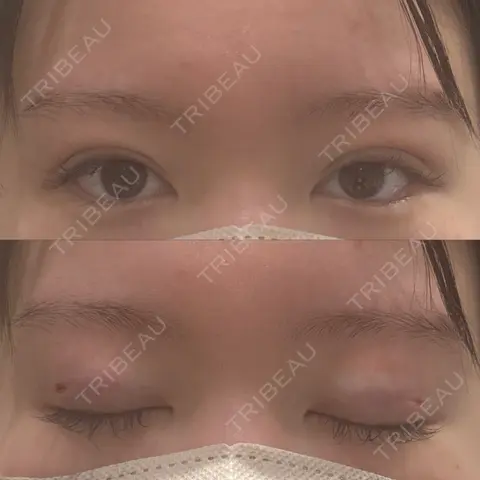 二重埋没 / 上まぶたの脂肪取り Shion Beauty Clinic DAY 0